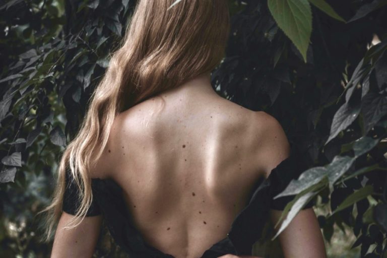 Kenali Perbedaan Tahi Lalat Normal dan Gejala Melanoma