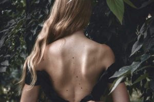 Kenali Perbedaan Tahi Lalat Normal dan Gejala Melanoma