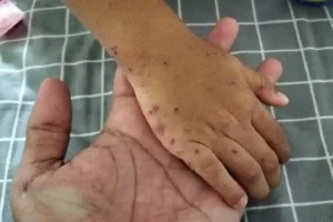 Kasus Flu Singapura Merebak di Kabupaten Batang, Khususnya pada Anak-Anak Sesuai namnya, Flu Singapura atau Hand, Foot, Mouth Diseases (HFMD) menyerang kaki, tangan, dan mulut. (foto: Dok Humas Pemkab Batang)