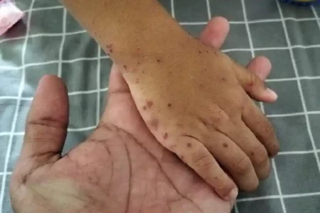 Sesuai namnya, Flu Singapura atau Hand, Foot, Mouth Diseases (HFMD) menyerang kaki, tangan, dan mulut. (foto: Dok Humas Pemkab Batang)